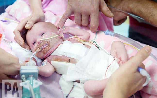 UK: Miracle baby born with heart outside body survives after three surgeries