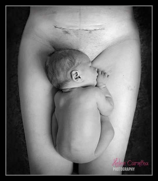 Mother' Powerful C-Section Photo Goes Viral!!!