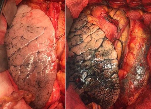 Arvind Kejriwal posts image of lungs to emphasize on the need of the Odd-Even rule